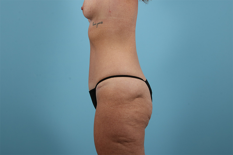 Abdominoplasty Before & After Image