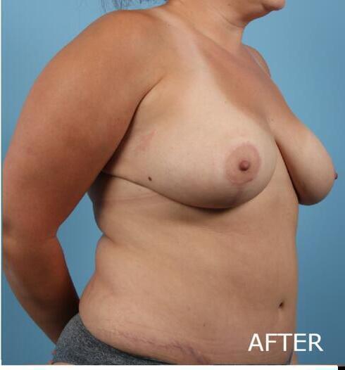 Mommy Makeover Before & After Image