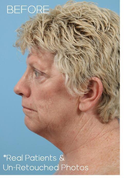 Facial Fat Grafting Before & After Image