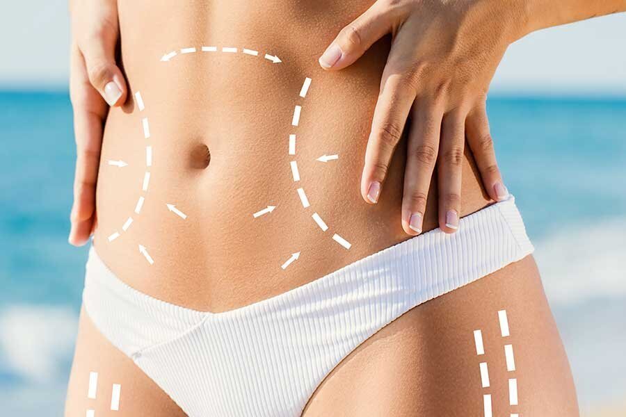 What Is Involved With A Tummy Tuck Procedure?