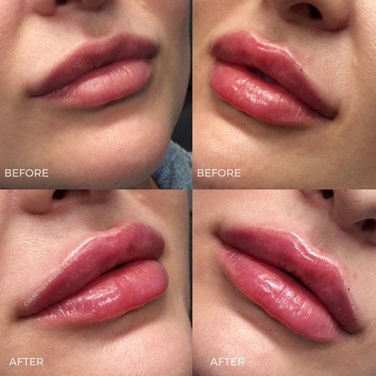 botox injectons for lips n.c Lip Fillers Charlotte