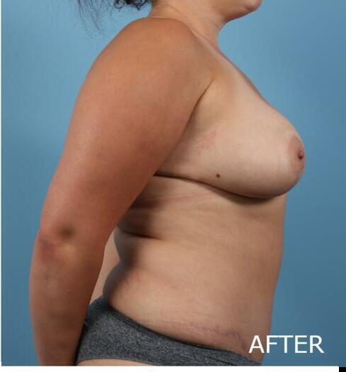 Mommy Makeover Before & After Image