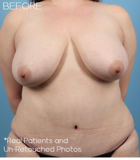 Liposuction Before & After Image