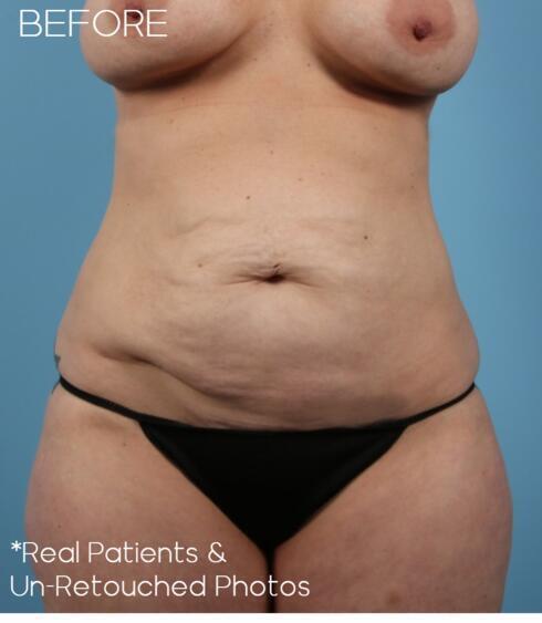 Liposuction Before & After Image