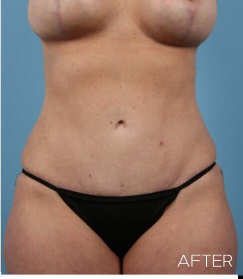 Liposuction Before & After Image