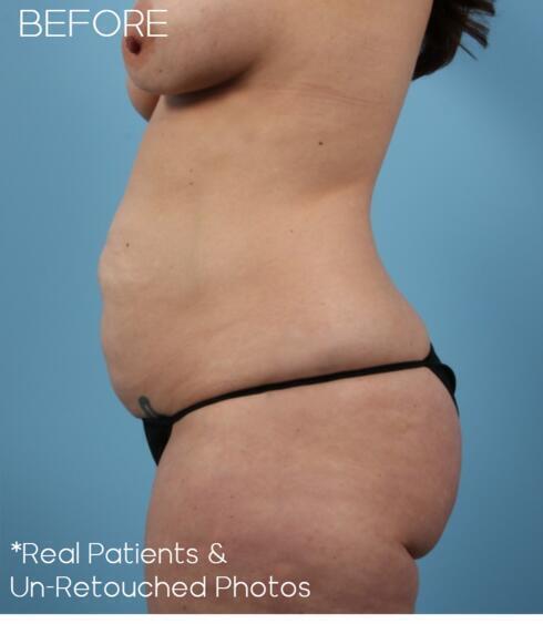 Liposuction Before & After Image