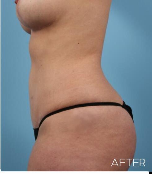 Liposuction Before & After Image