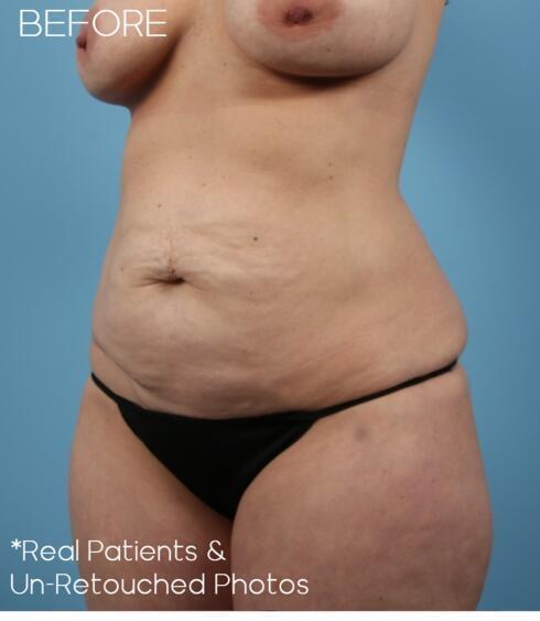 Liposuction Before & After Image