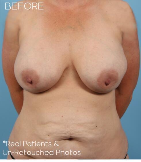 Liposuction Before & After Image