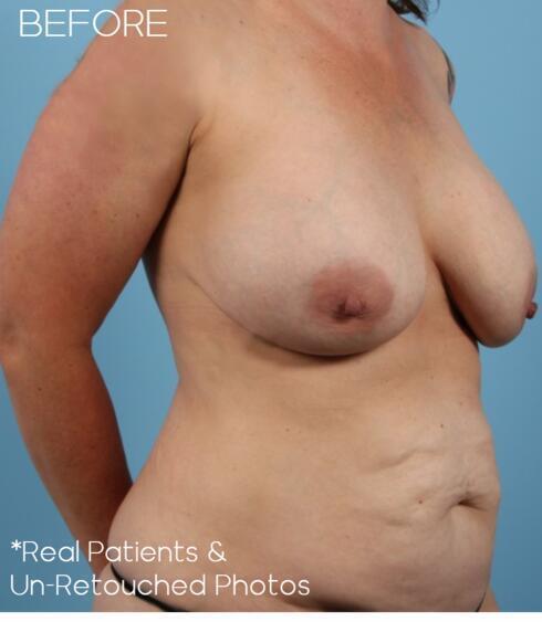 Liposuction Before & After Image