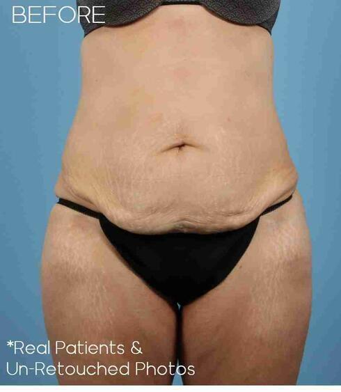 Liposuction Before & After Image