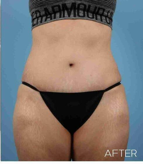 Liposuction Before & After Image