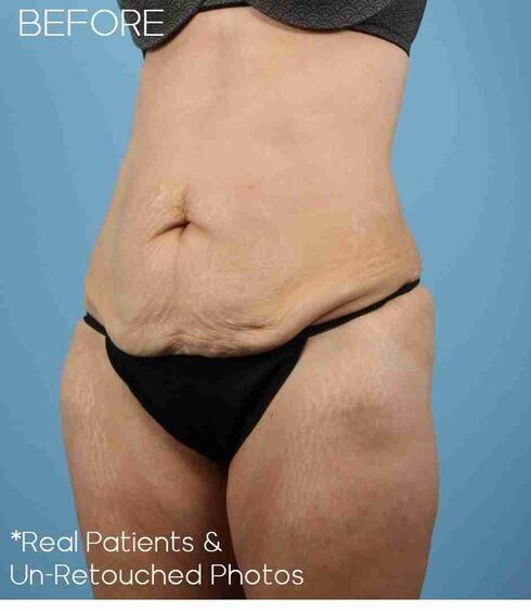 Liposuction Before & After Image