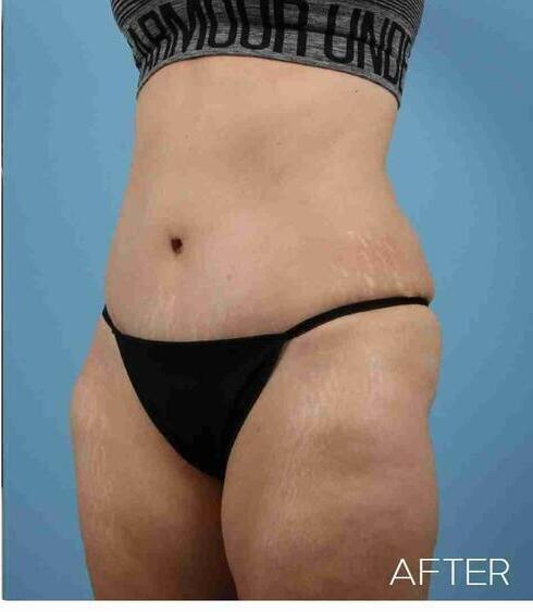 Liposuction Before & After Image