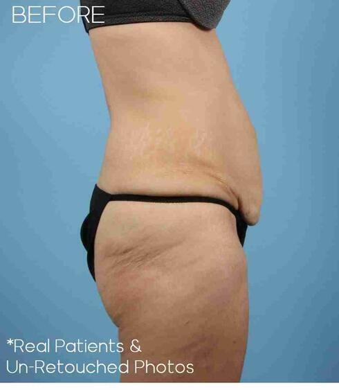 Liposuction Before & After Image