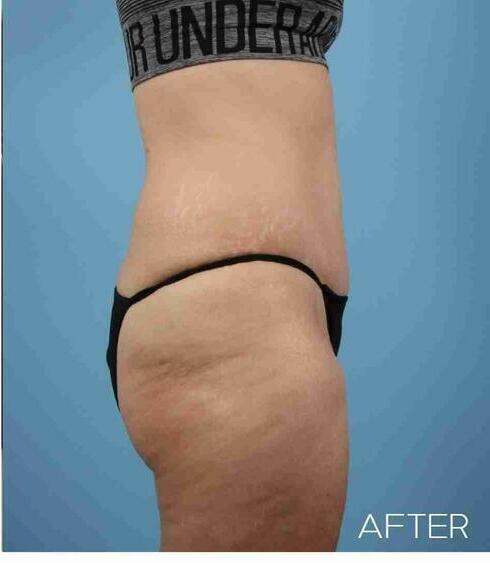 Liposuction Before & After Image