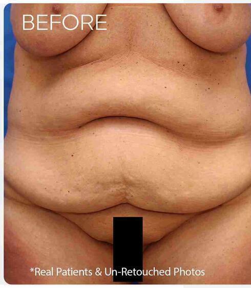 Liposuction Before & After Image