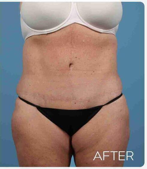 Liposuction Before & After Image