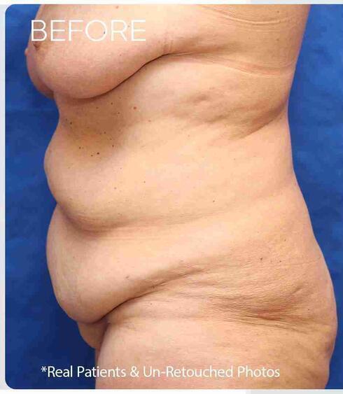 Liposuction Before & After Image