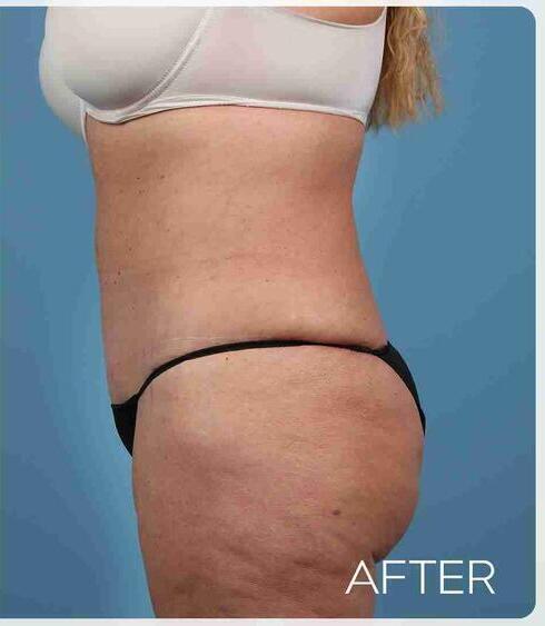 Liposuction Before & After Image