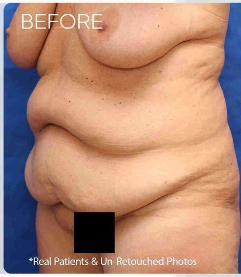 Liposuction Before & After Image