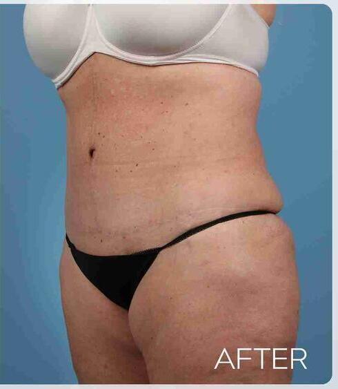 Liposuction Before & After Image