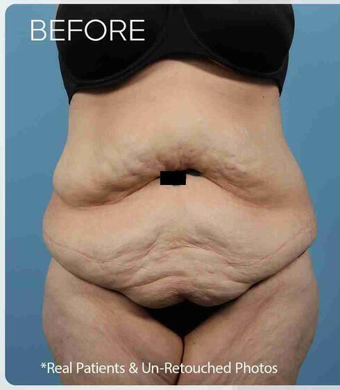 Liposuction Before & After Image