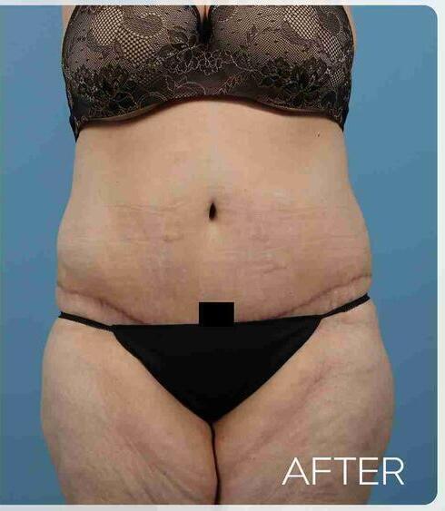 Liposuction Before & After Image