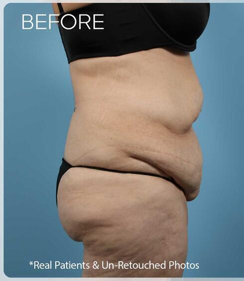 Liposuction Before & After Image