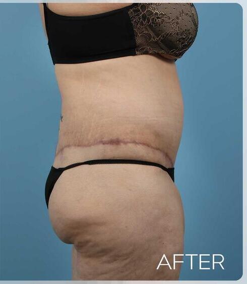 Liposuction Before & After Image