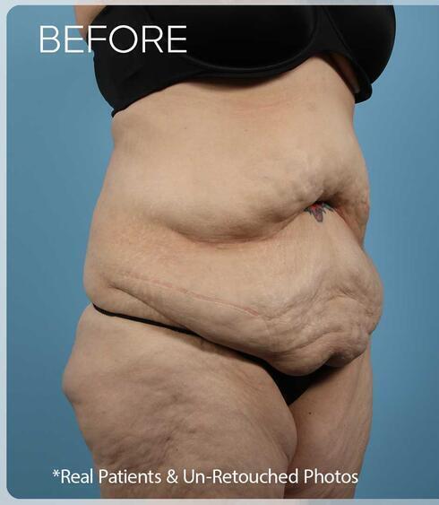 Liposuction Before & After Image