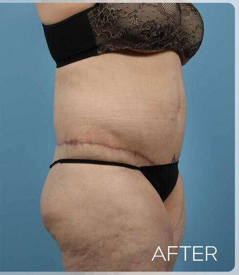 Liposuction Before & After Image