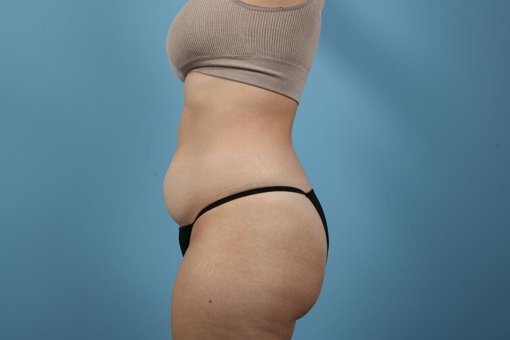 Liposuction Before & After Image