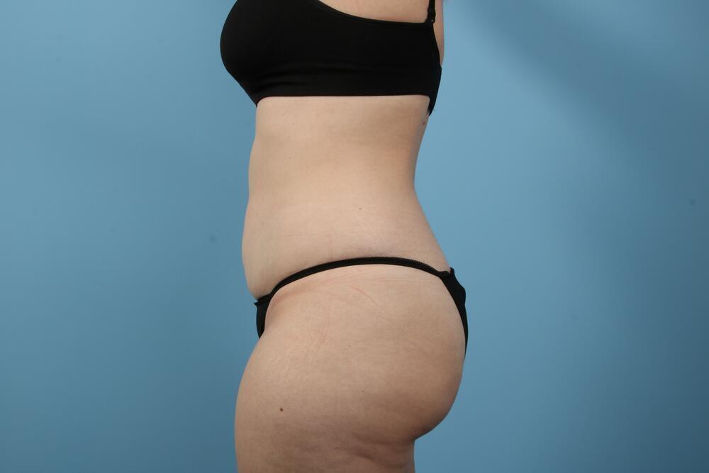 Liposuction Before & After Image