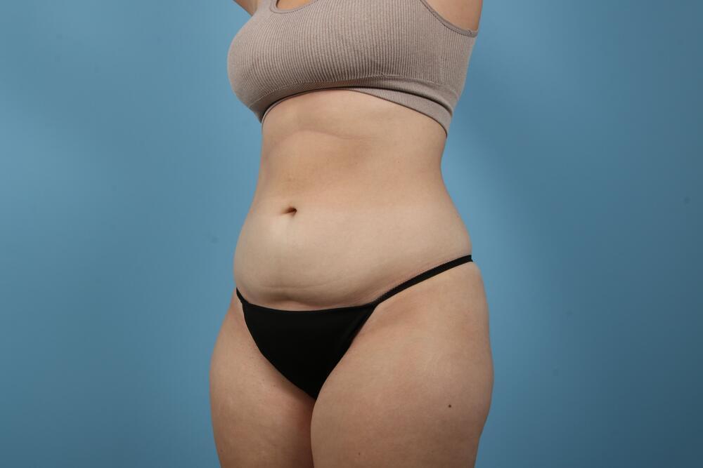 Liposuction Before & After Image