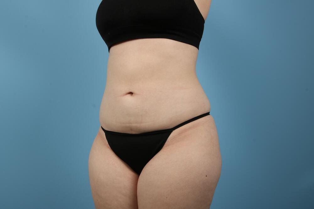 Liposuction Before & After Image