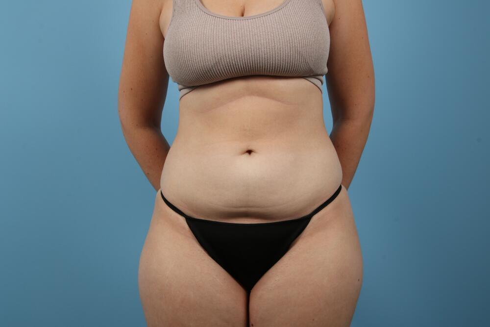 Liposuction Before & After Image