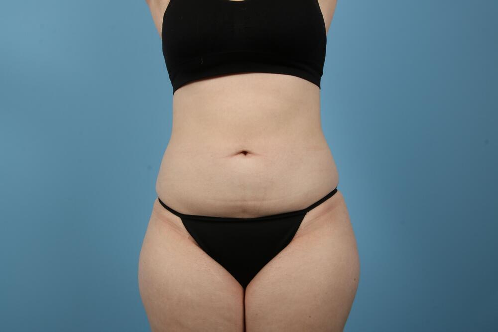 Liposuction Before & After Image