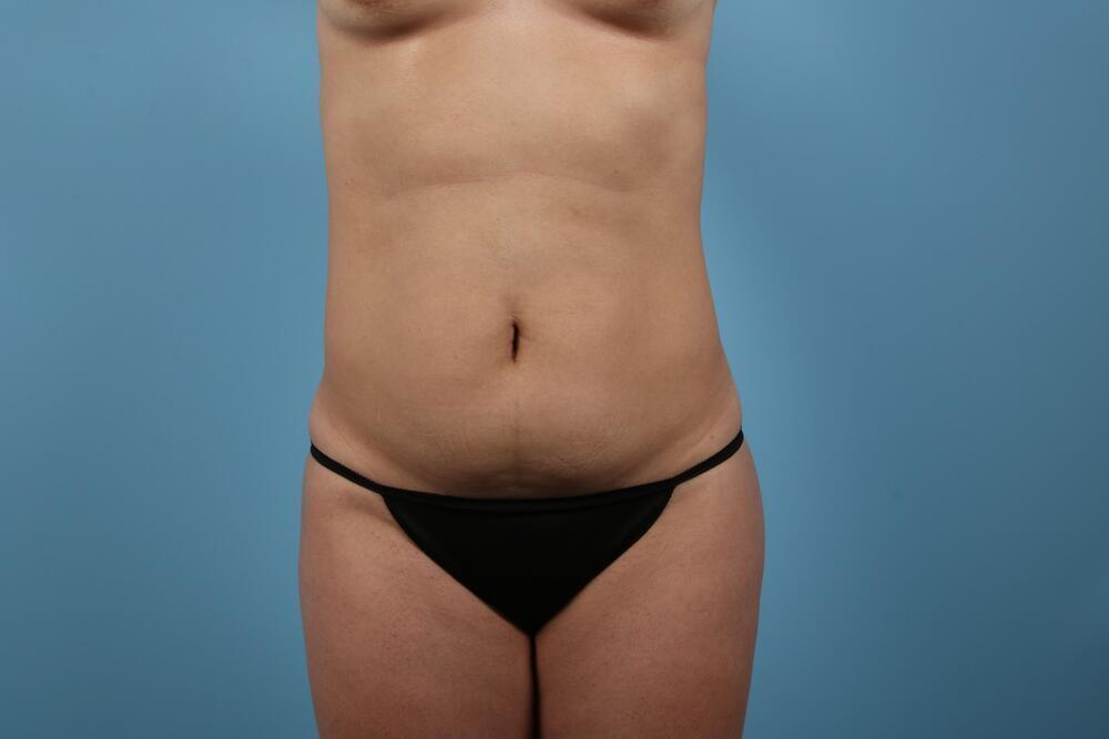 Liposuction Before & After Image