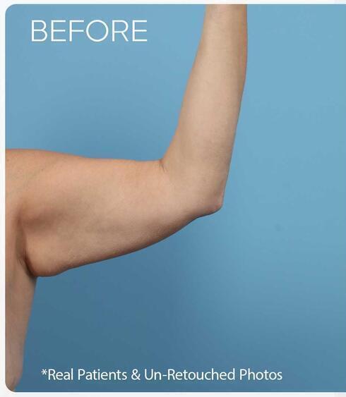 Body Thigh Arm Lifts Before & After Image