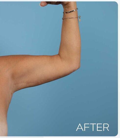 Body Thigh Arm Lifts Before & After Image