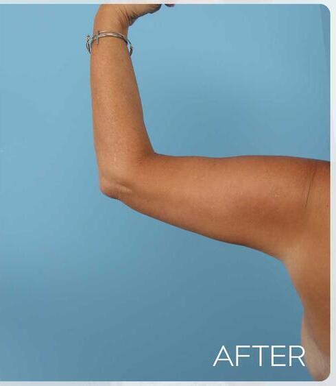 Body Thigh Arm Lifts Before & After Image