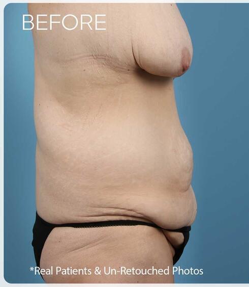 Post Massive Weight Loss Surgery Before & After Image