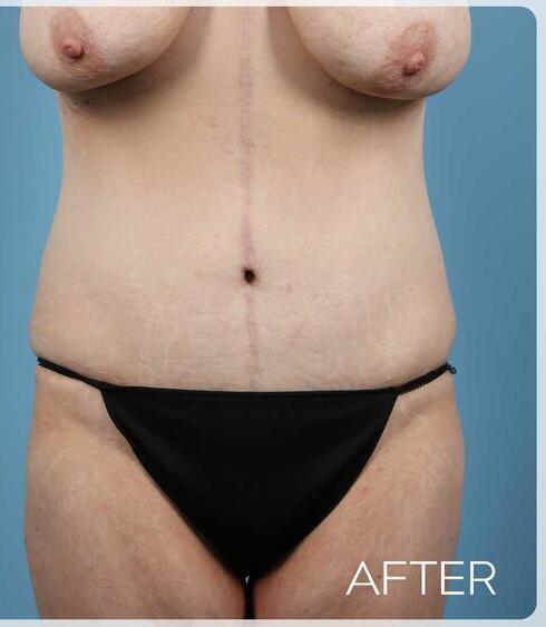 Post Massive Weight Loss Surgery Before & After Image