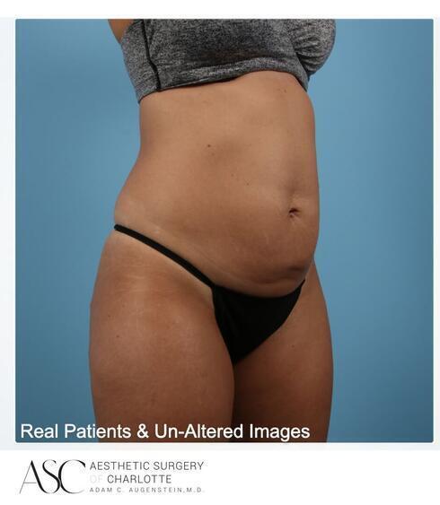 Abdominoplasty Before & After Image