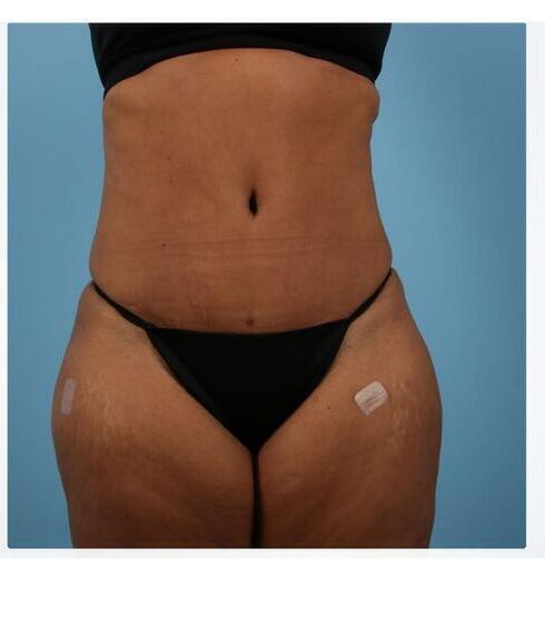 Abdominoplasty Before & After Image