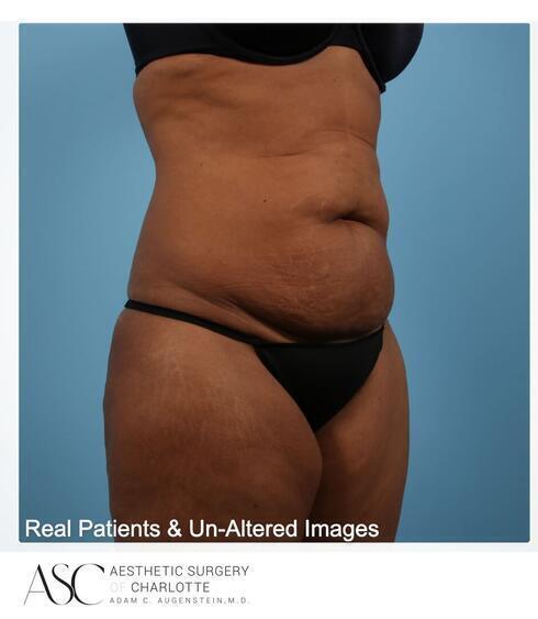 Abdominoplasty Before & After Image