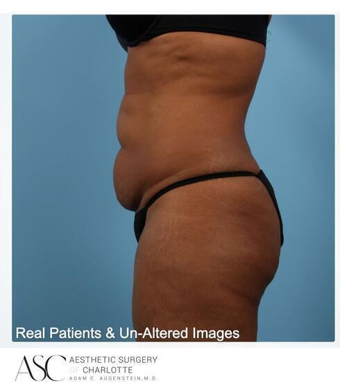 Abdominoplasty Before & After Image