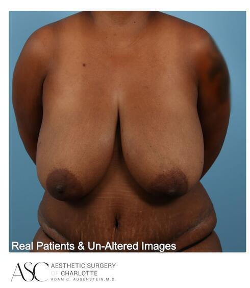 Abdominoplasty Before & After Image