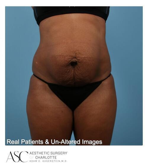 Abdominoplasty Before & After Image